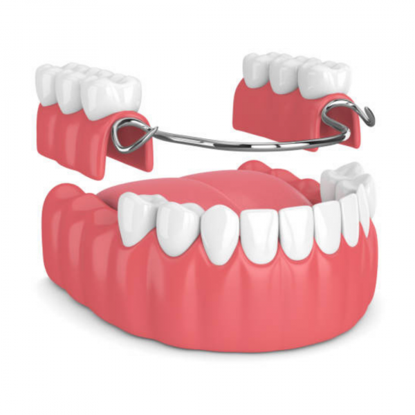 Prótesis dental removible parcial